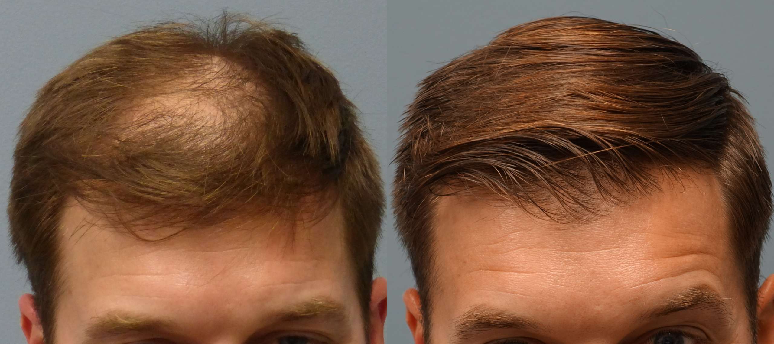 Haartransplantation