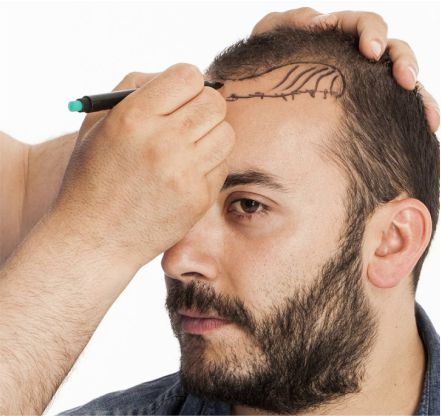 Haartransplantation